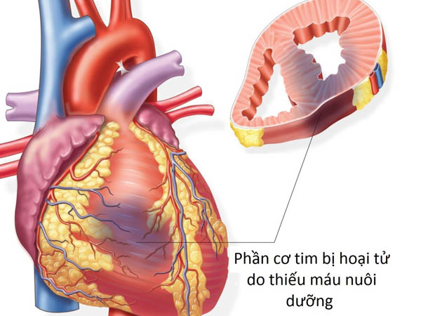 Coronary Artery Disease - Hình ảnh minh họa